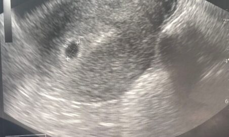 5 Weeks Ultrasound - Radiologystar