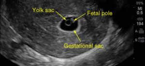  Fetal Pole At 5 Weeks
