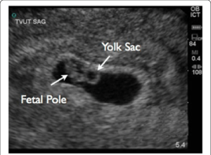 Fetal Pole
