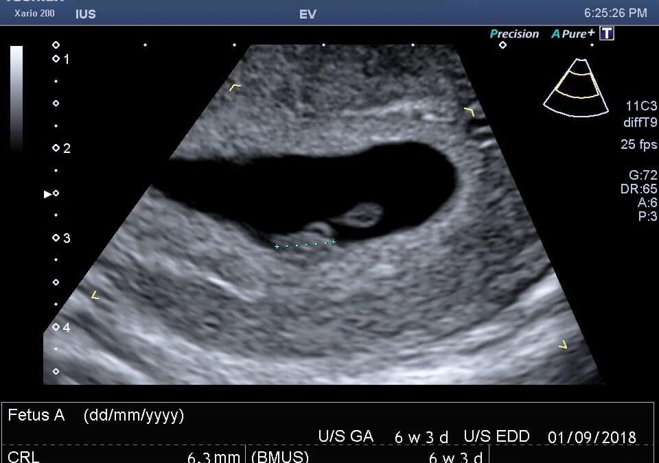 ultrasound at 6 weeks