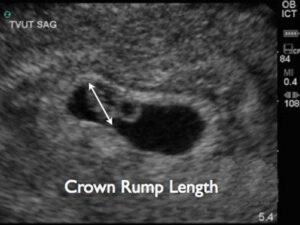 Crown-rump length