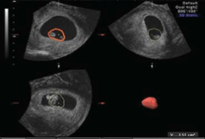 Gestational sac size of ultrasound at 8 weeks