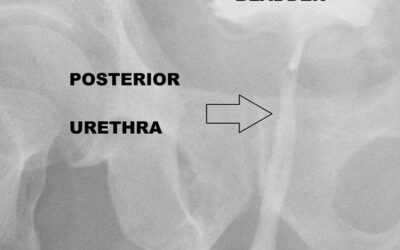 Retrograde Urethrography(RGU)