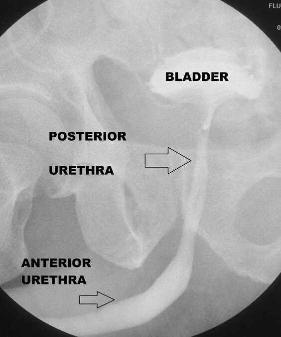 Retrograde Urethrography(RGU)