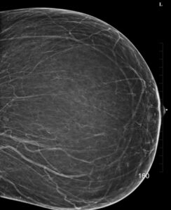 gigantomastia of mamography