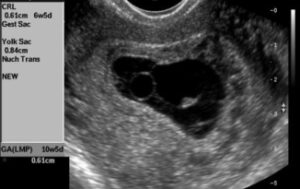 8 week ultrasound with Enlarged yolk sac