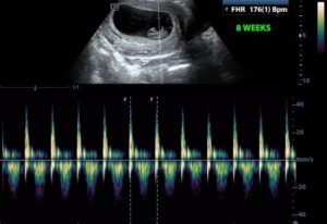 8 week ultrasound of Fetal heart rate (FHR)
