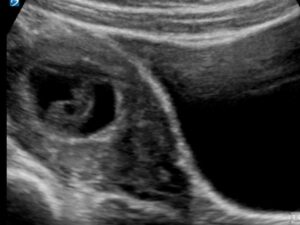 8 week ultrasound with Miscarriage