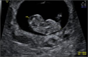 8 week ultrasound of Crown-rump length (CRL)