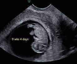 9 Week Ultrasound