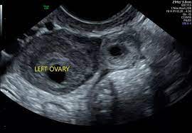 8 week ultrasound with Ectopic pregnancy