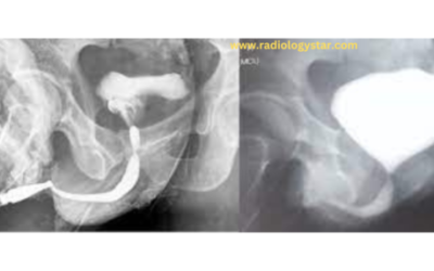 Micturating Cysto Urethrogram (MCU)