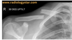 Fracture of clavicle