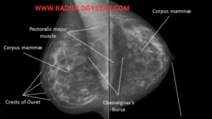 mammography image from x-ray
