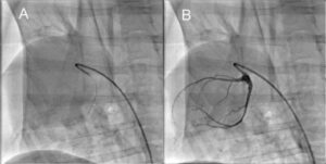 Cardiac Catheterization in fluoroscopy
