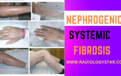 Nephrogenic Systemic Fibrosis