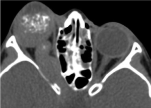 Retinoblastoma