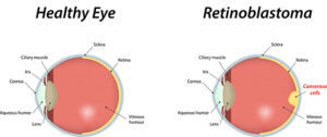 Retinoblastoma