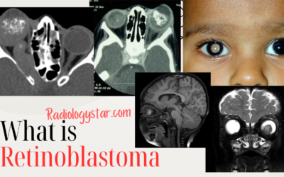 Retinoblastoma