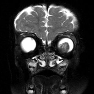 Retinoblastoma